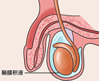 鞘膜积液